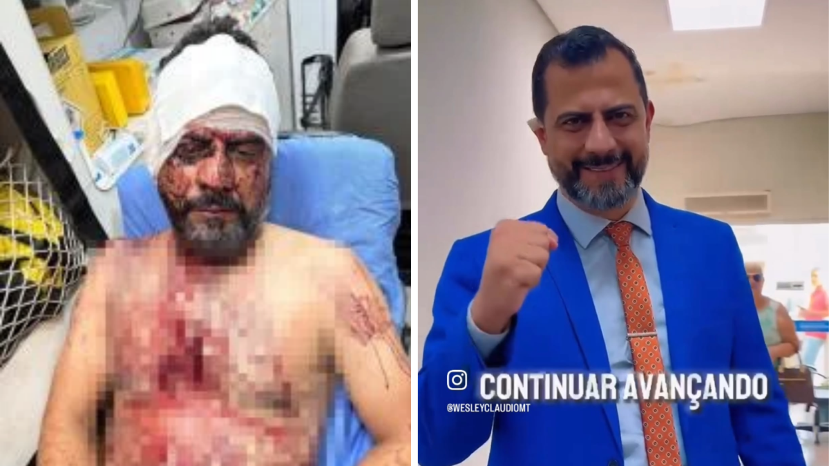 Vereador volta à Câmara após agressão e orelha cortada durante assalto